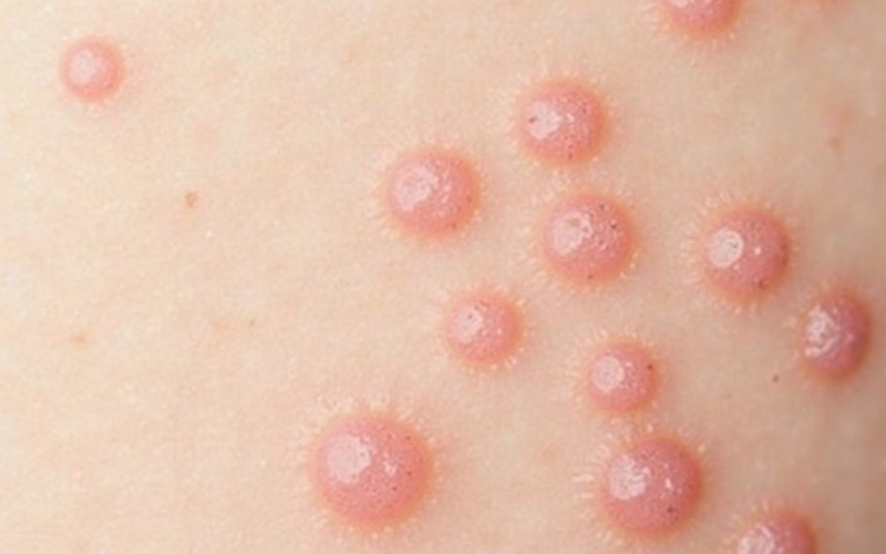 Featured image for blog post: Warts and Molluscum: Contagious but Treatable Skin Conditions - AI generated illustration